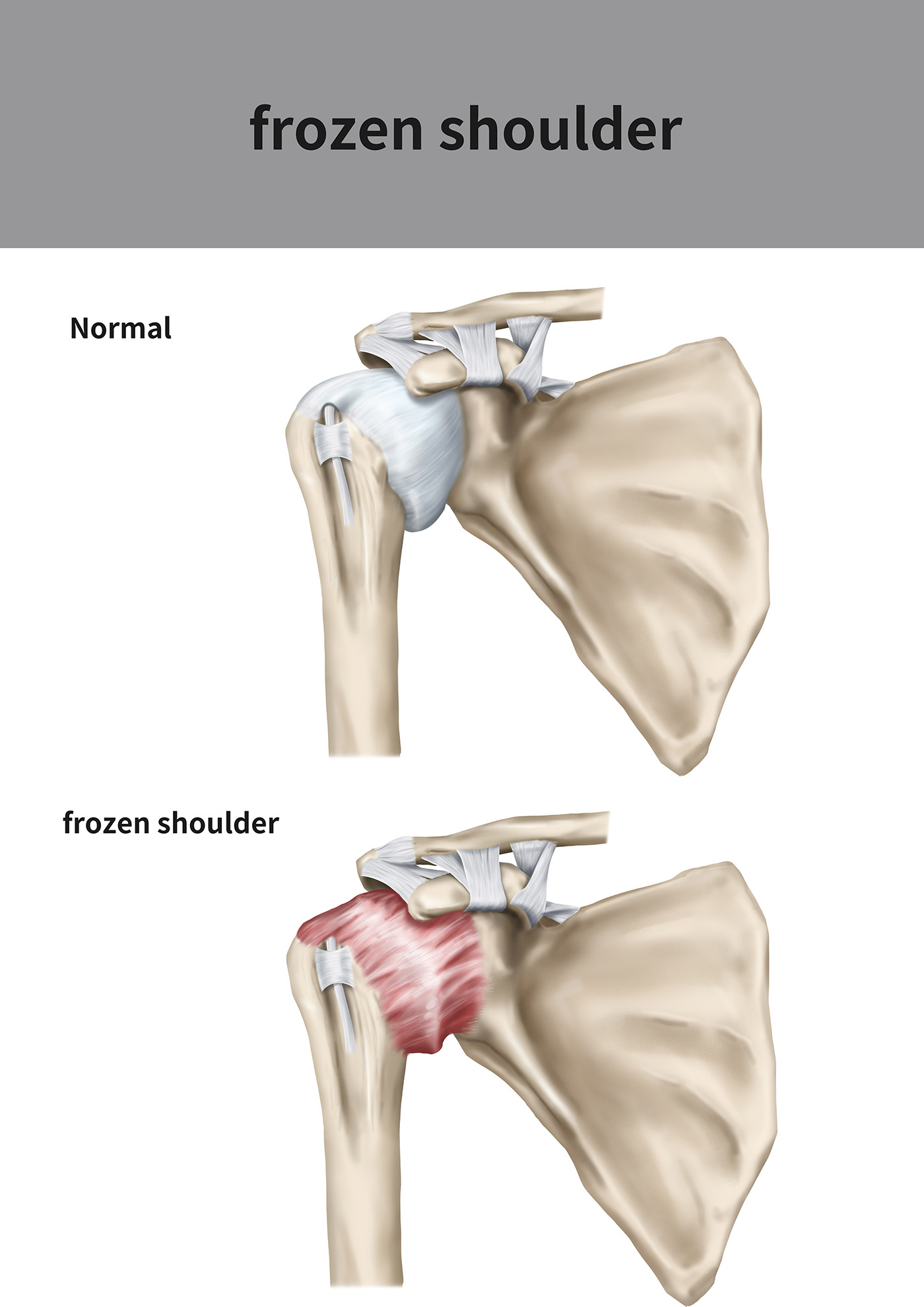 Ein Knochenbild von einer normalen Schulter und eins von einer eingefrorenen Schulter